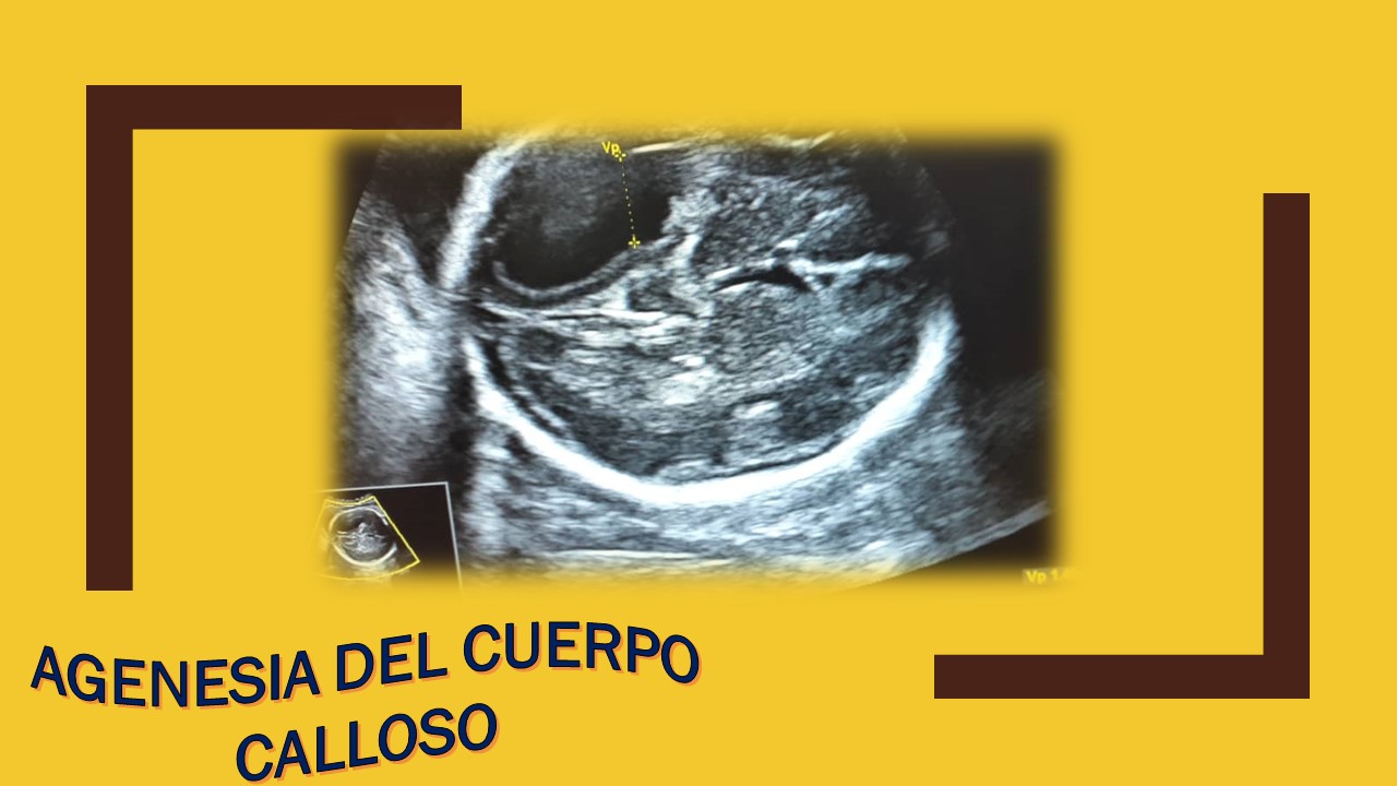 agenesia cuerpo calloso ultrasonido fetal completo